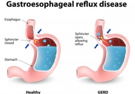 What is Acid Reflux disease?
