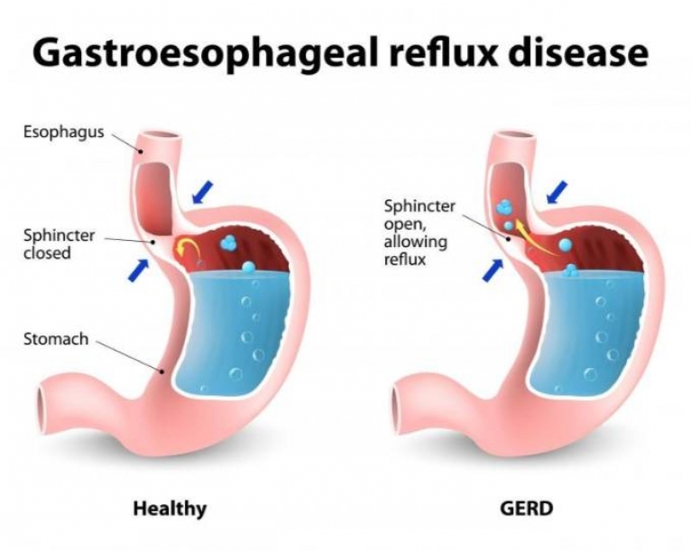 What is Acid Reflux disease?